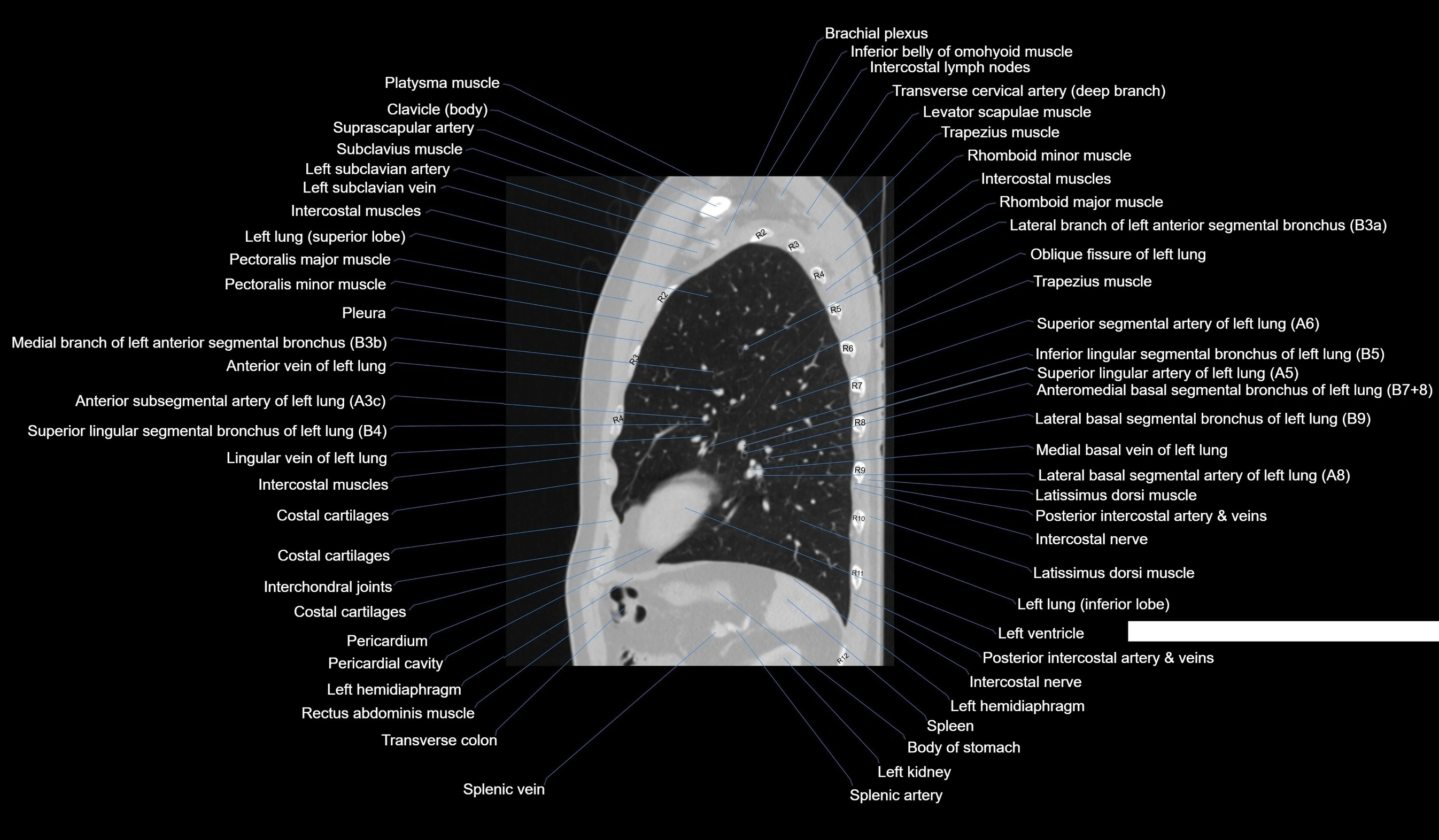 CT chest (thorax) lung window labelled sagittal cross sectional anatomy radiology image-00104.webp